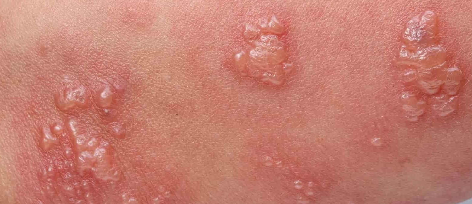 Mụn Rộp Sinh Dục Khiến Bạn Bị Loét ở Vùng Kín